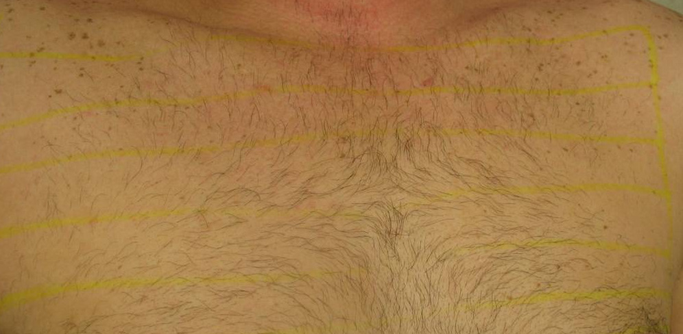 The Most Common Hair Removal Procedures Is Underarm Laser ...