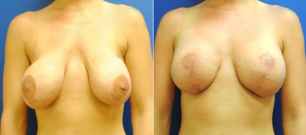 Before & After Breast Revision Photos