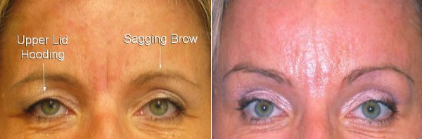 Before & After Brow Lift Photos