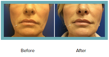 Botox Injection Results St. Louis