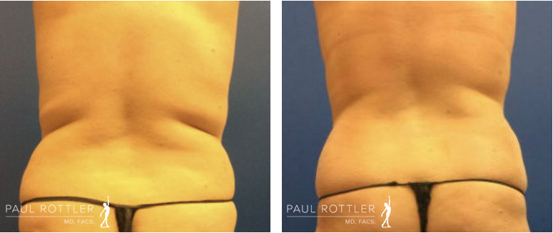 Before & After Exilis Ultra 360 Photos