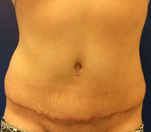 Tummy Tuck