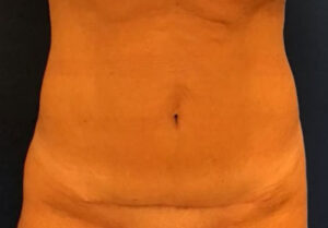 Tummy Tuck