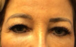 Blepharoplasty