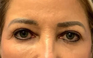 Blepharoplasty