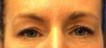 Blepharoplasty