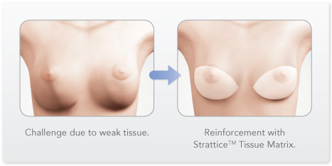Treatment for Bottoming Out Breast Implants